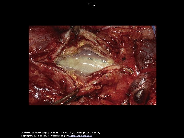 Fig 4 Journal of Vascular Surgery 2013 58371 -379 DOI: (10. 1016/j. jvs. 2013.