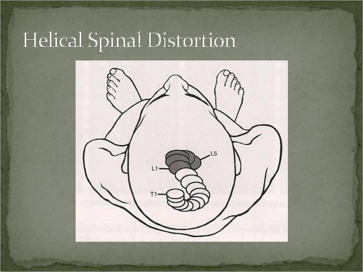 Helical Spinal Distortion 