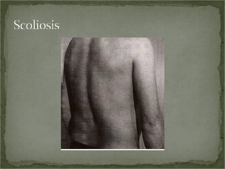 Scoliosis 