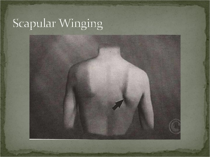 Scapular Winging 