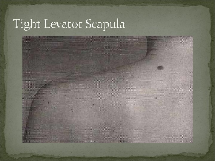 Tight Levator Scapula 