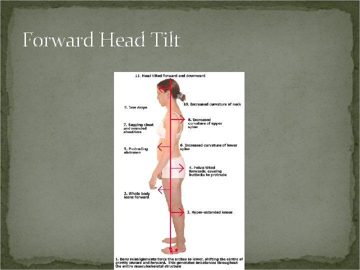 Forward Head Tilt 