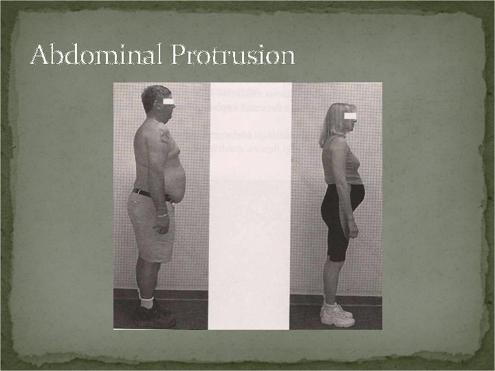 Abdominal Protrusion 