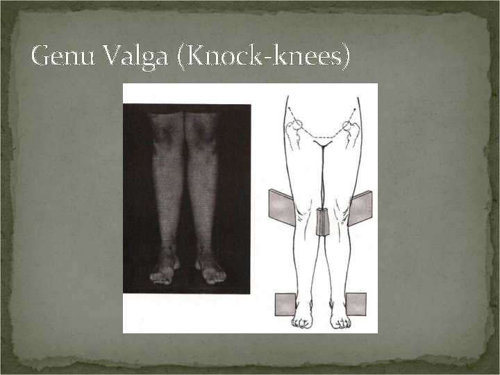 Genu Valga (Knock-knees) 