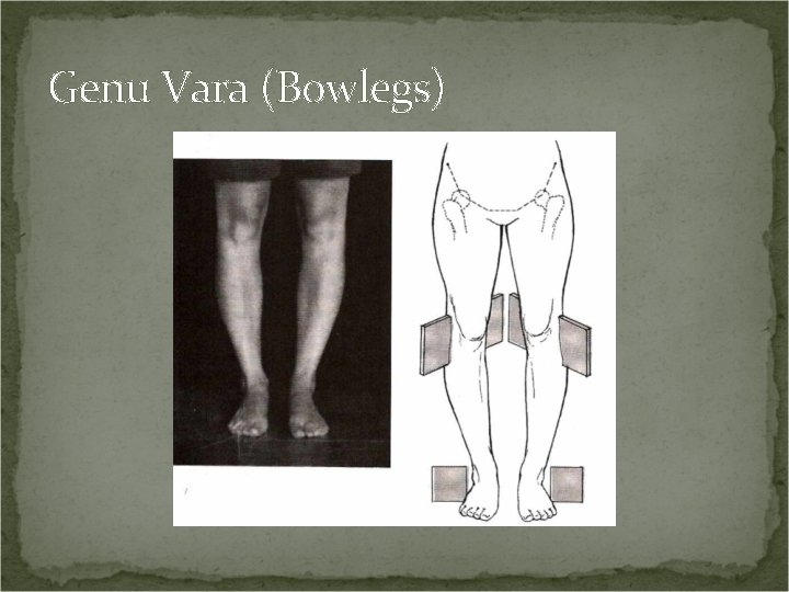 Genu Vara (Bowlegs) 