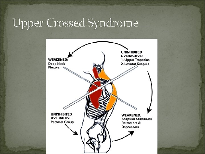 Upper Crossed Syndrome 