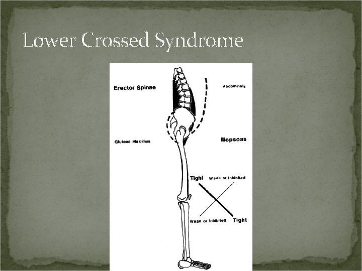 Lower Crossed Syndrome 