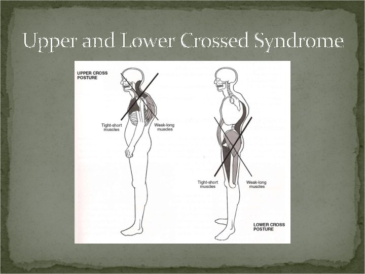 Upper and Lower Crossed Syndrome 