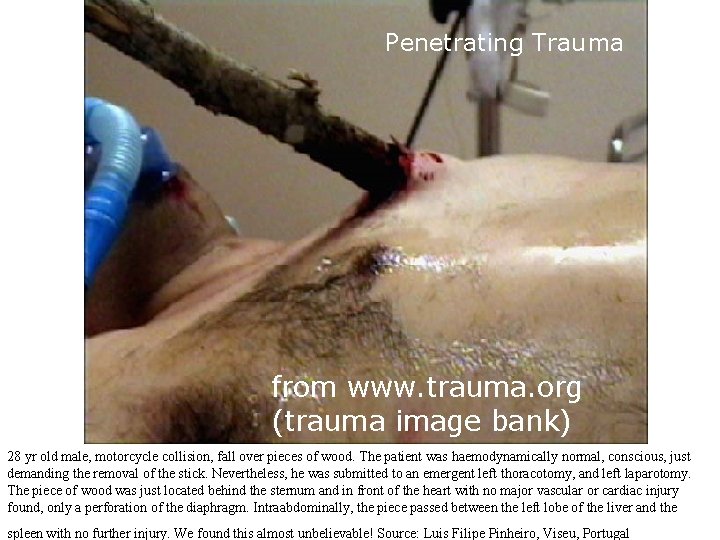 Penetrating Trauma from www. trauma. org (trauma image bank) 28 yr old male, motorcycle