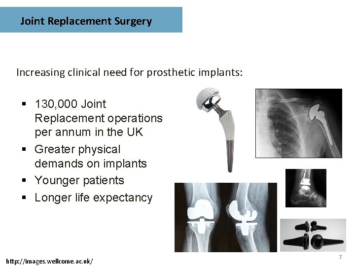 Joint Replacement Surgery Increasing clinical need for prosthetic implants: § 130, 000 Joint Replacement