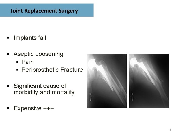 Joint Replacement Surgery § Implants fail § Aseptic Loosening § Pain § Periprosthetic Fracture