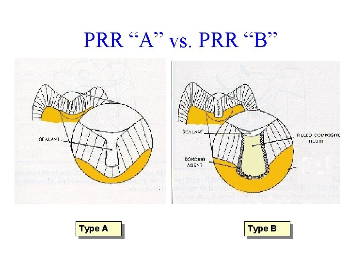 PRR “A” vs. PRR “B” Type A Type B 