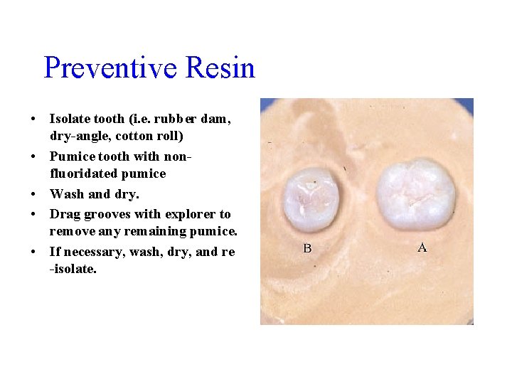 Preventive Resin • Isolate tooth (i. e. rubber dam, dry-angle, cotton roll) • Pumice