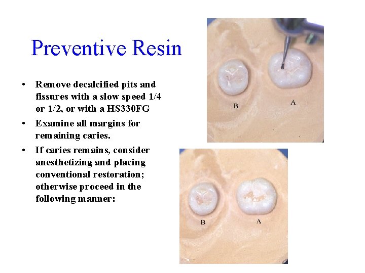 Preventive Resin • Remove decalcified pits and fissures with a slow speed 1/4 or