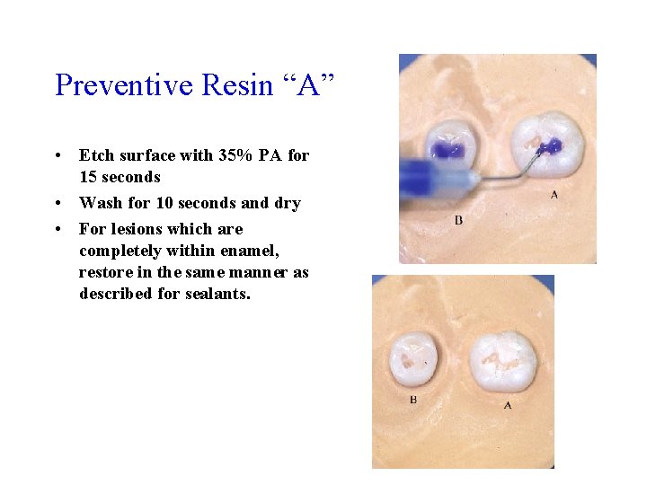 Preventive Resin “A” • Etch surface with 35% PA for 15 seconds • Wash