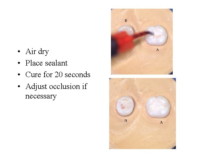  • • Air dry Place sealant Cure for 20 seconds Adjust occlusion if
