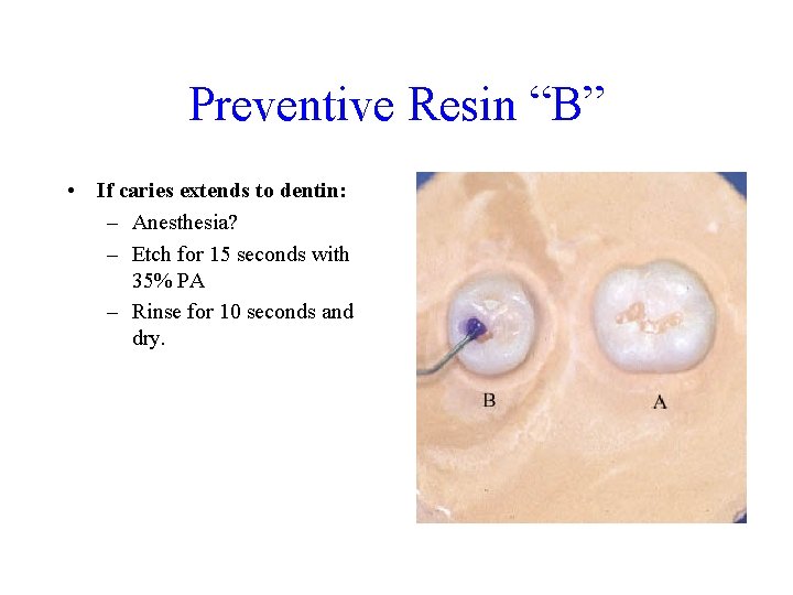 Preventive Resin “B” • If caries extends to dentin: – Anesthesia? – Etch for