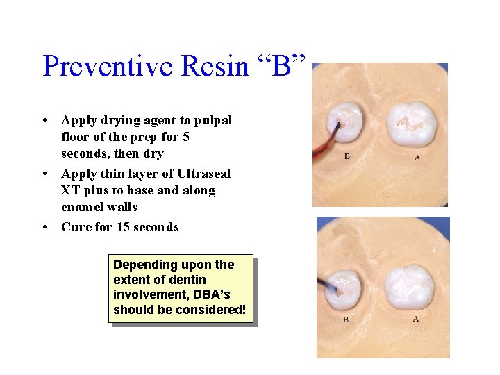 Preventive Resin “B” • Apply drying agent to pulpal floor of the prep for