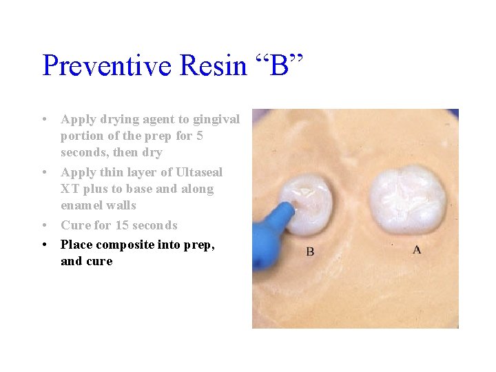 Preventive Resin “B” • Apply drying agent to gingival portion of the prep for