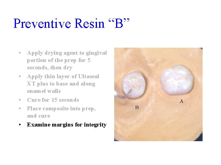 Preventive Resin “B” • Apply drying agent to gingival portion of the prep for