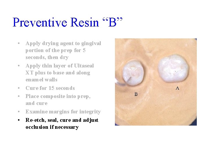 Preventive Resin “B” • Apply drying agent to gingival portion of the prep for