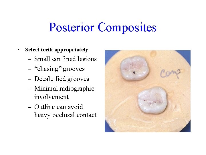 Posterior Composites • Select teeth appropriately – – Small confined lesions “chasing” grooves Decalcified