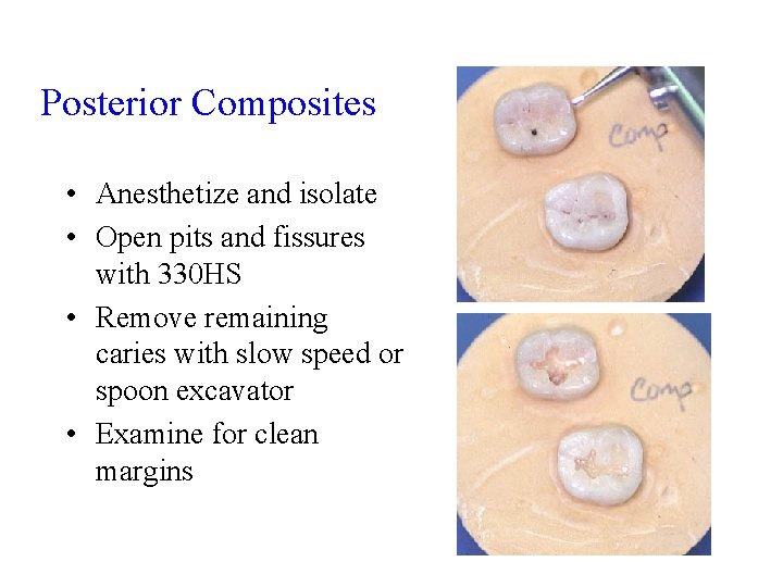 Posterior Composites • Anesthetize and isolate • Open pits and fissures with 330 HS