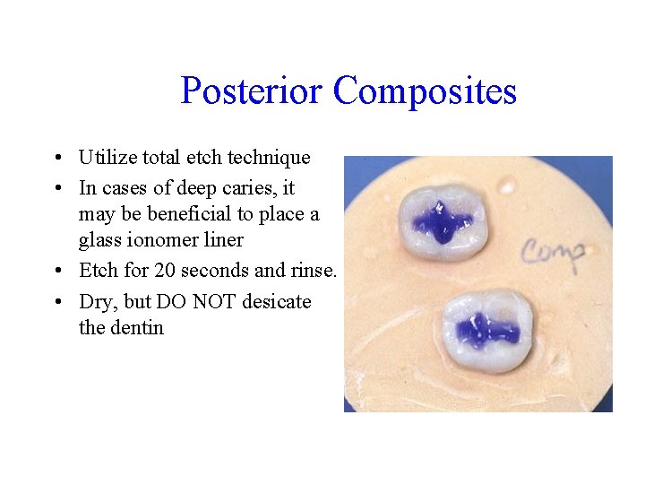 Posterior Composites • Utilize total etch technique • In cases of deep caries, it