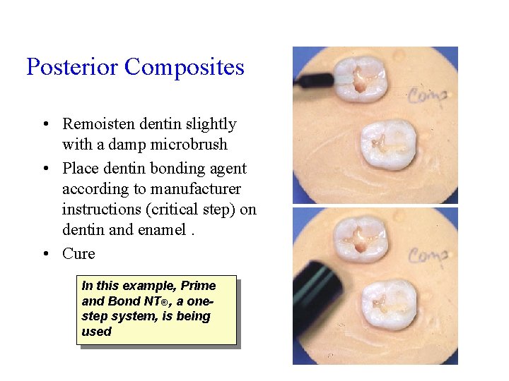 Posterior Composites • Remoisten dentin slightly with a damp microbrush • Place dentin bonding