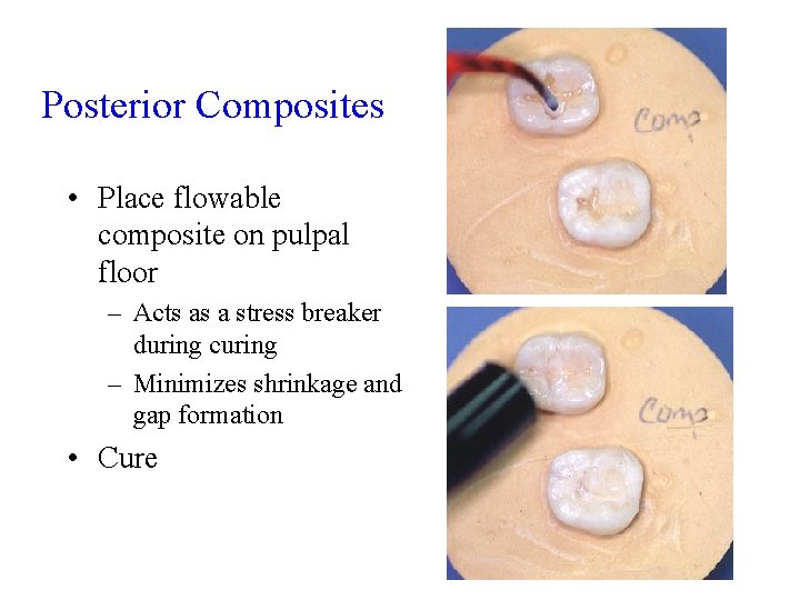 Posterior Composites • Place flowable composite on pulpal floor – Acts as a stress