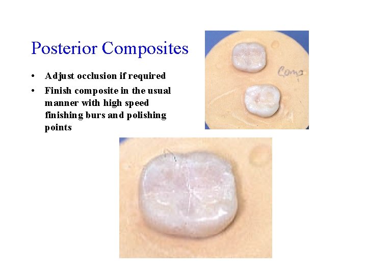 Posterior Composites • Adjust occlusion if required • Finish composite in the usual manner