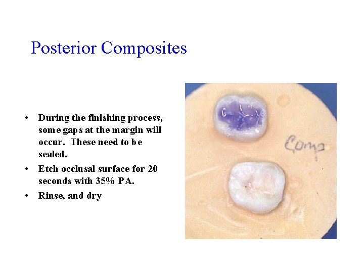 Posterior Composites • During the finishing process, some gaps at the margin will occur.