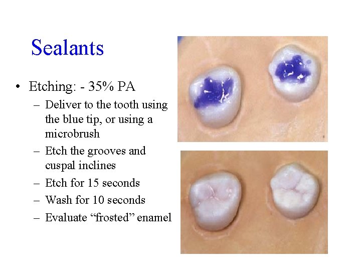 Sealants • Etching: - 35% PA – Deliver to the tooth using the blue