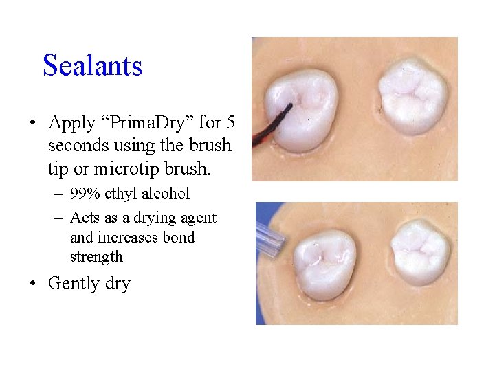 Sealants • Apply “Prima. Dry” for 5 seconds using the brush tip or microtip