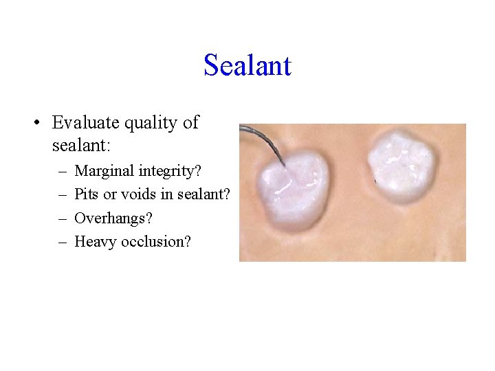 Sealant • Evaluate quality of sealant: – – Marginal integrity? Pits or voids in