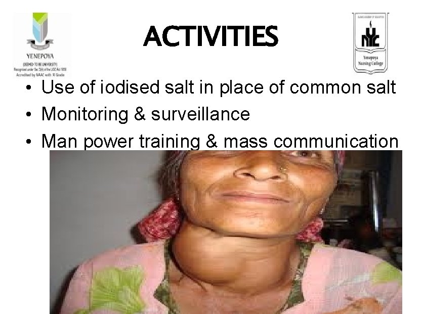 ACTIVITIES • Use of iodised salt in place of common salt • Monitoring &