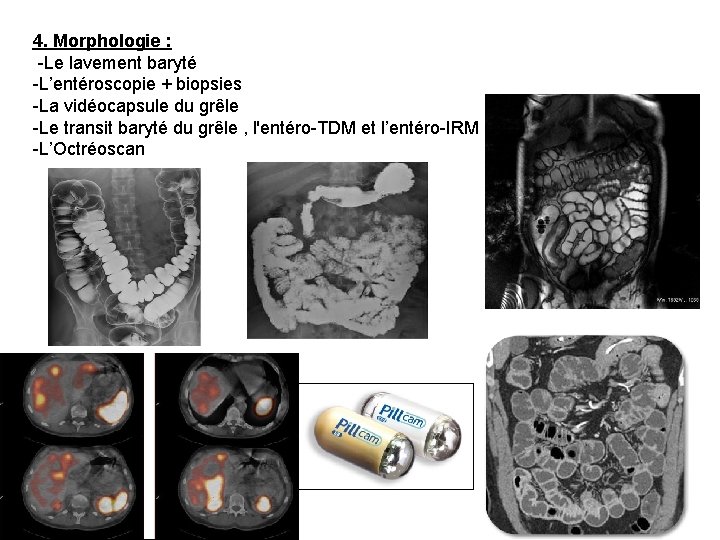 4. Morphologie : -Le lavement baryté -L’entéroscopie + biopsies -La vidéocapsule du grêle -Le