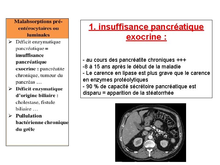 1. insuffisance pancréatique exocrine : - au cours des pancréatite chroniques +++ -8 à