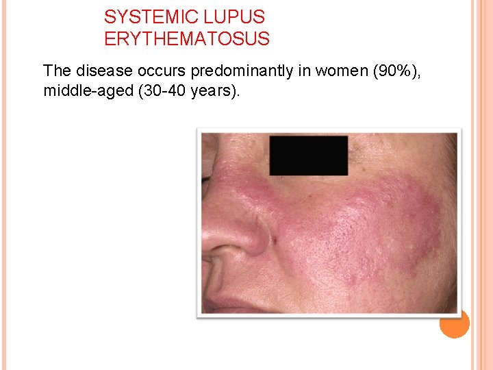 SYSTEMIC LUPUS ERYTHEMATOSUS The disease occurs predominantly in women (90%), middle-aged (30 -40 years).