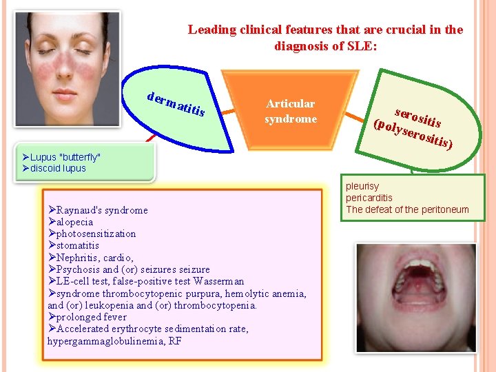 Leading clinical features that are crucial in the diagnosis of SLE: derm atiti s