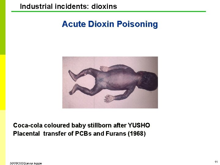 Industrial incidents: dioxins Acute Dioxin Poisoning Coca-cola coloured baby stillborn after YUSHO Placental transfer