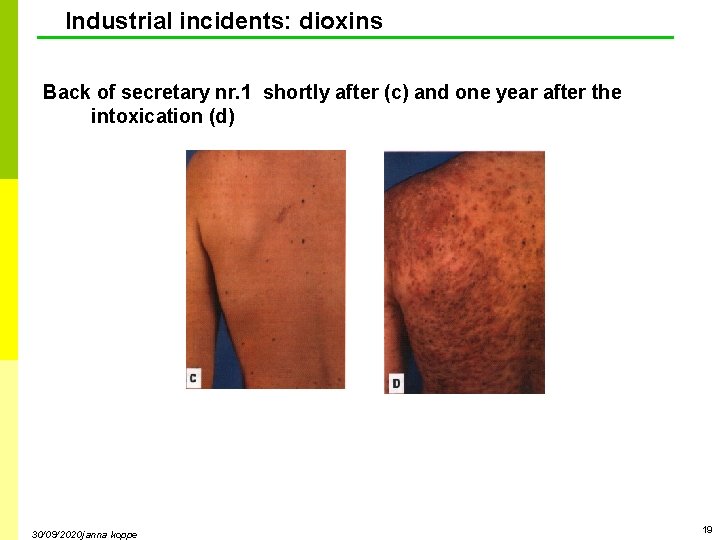 Industrial incidents: dioxins Back of secretary nr. 1 shortly after (c) and one year Industrial incidents: dioxins Back of secretary nr. 1 shortly after (c) and one year