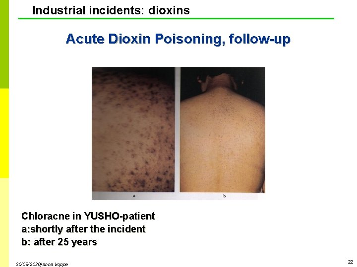 Industrial incidents: dioxins Acute Dioxin Poisoning, follow-up Chloracne in YUSHO-patient a: shortly after the