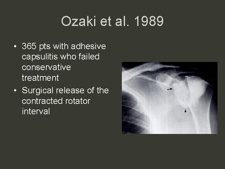 Ozaki et al. 1989 • 365 pts with adhesive capsulitis who failed conservative treatment