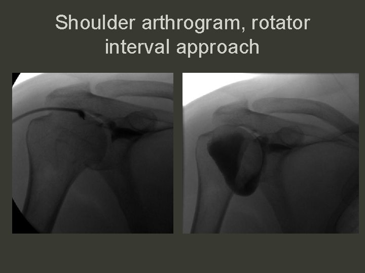 Shoulder arthrogram, rotator interval approach 