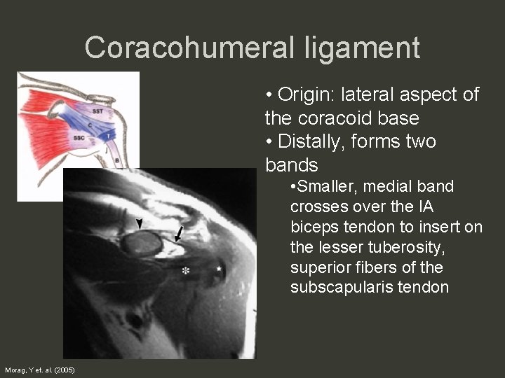 Coracohumeral ligament • Origin: lateral aspect of the coracoid base • Distally, forms two