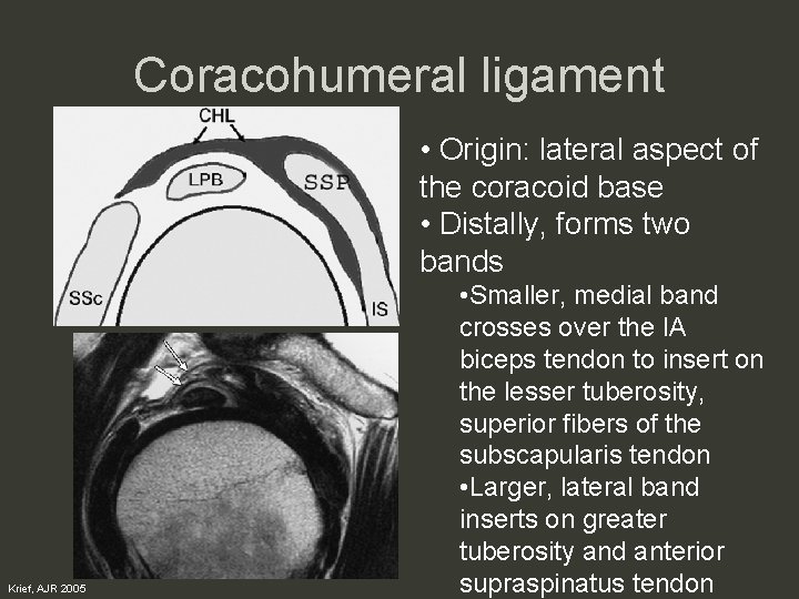 Coracohumeral ligament • Origin: lateral aspect of the coracoid base • Distally, forms two