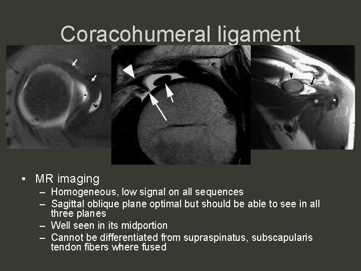 Coracohumeral ligament • MR imaging – Homogeneous, low signal on all sequences – Sagittal