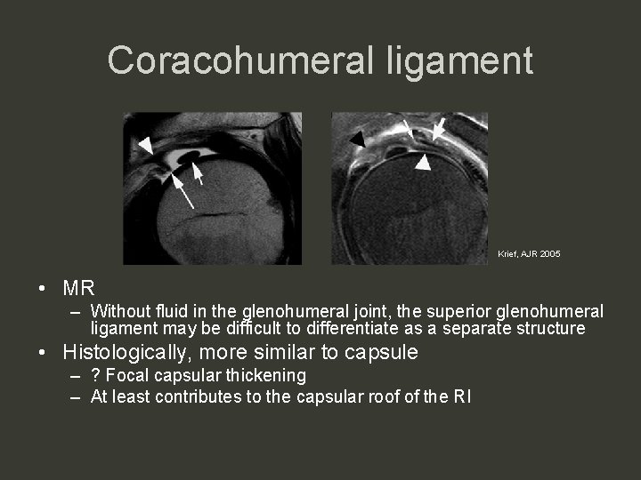 Coracohumeral ligament Krief, AJR 2005 • MR – Without fluid in the glenohumeral joint,