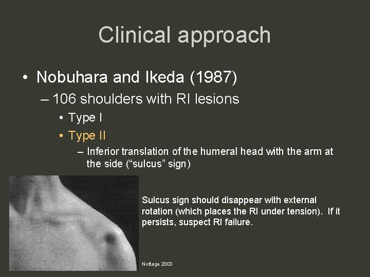 Clinical approach • Nobuhara and Ikeda (1987) – 106 shoulders with RI lesions •